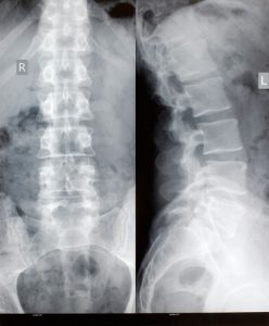 x-ray of a spine